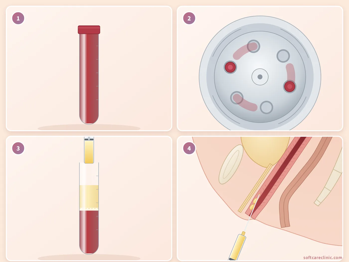 خطوات علاج PRP المهبلي خطوات علاج PRP المهبلي