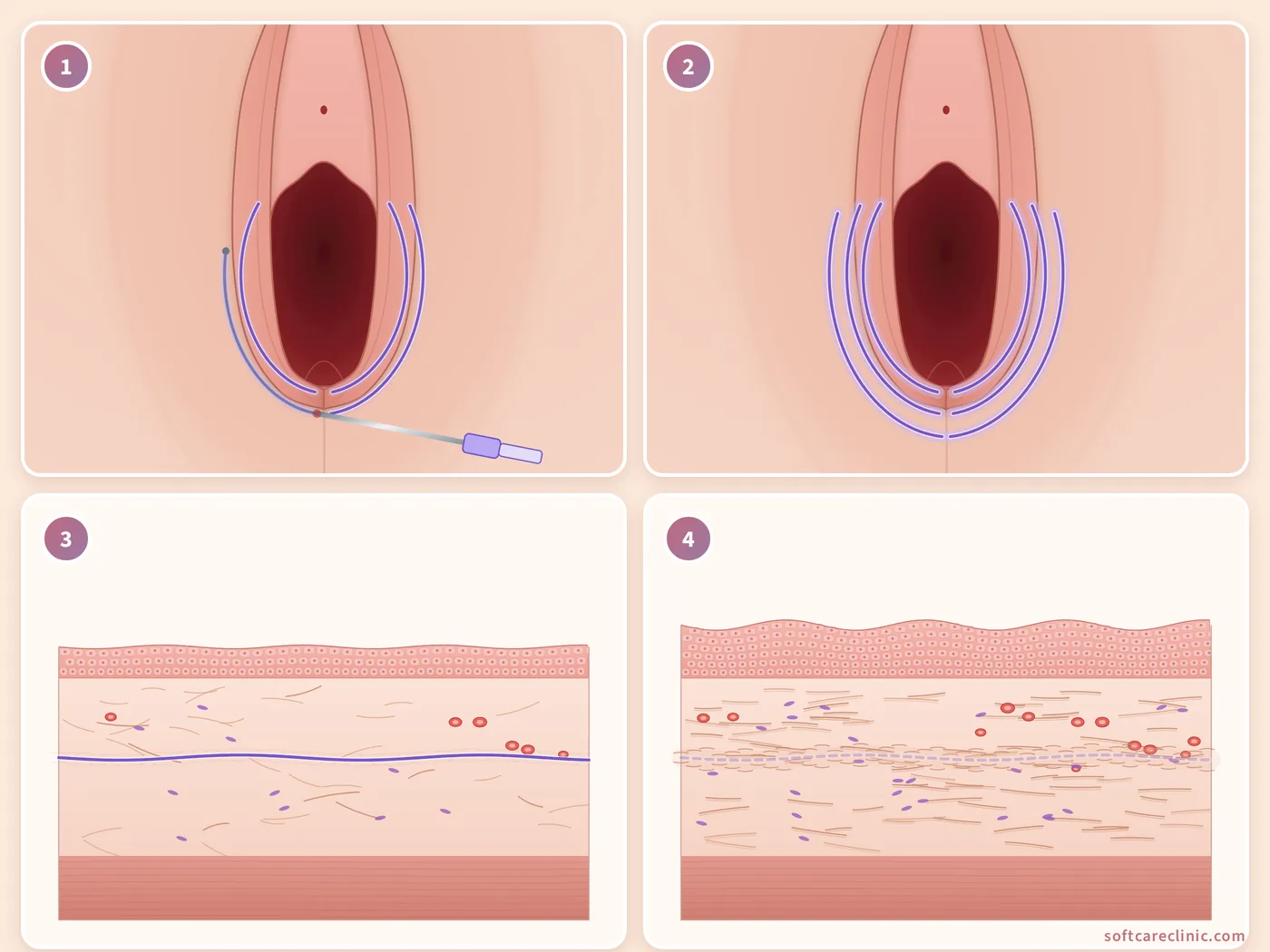 PDO thread treatment steps
