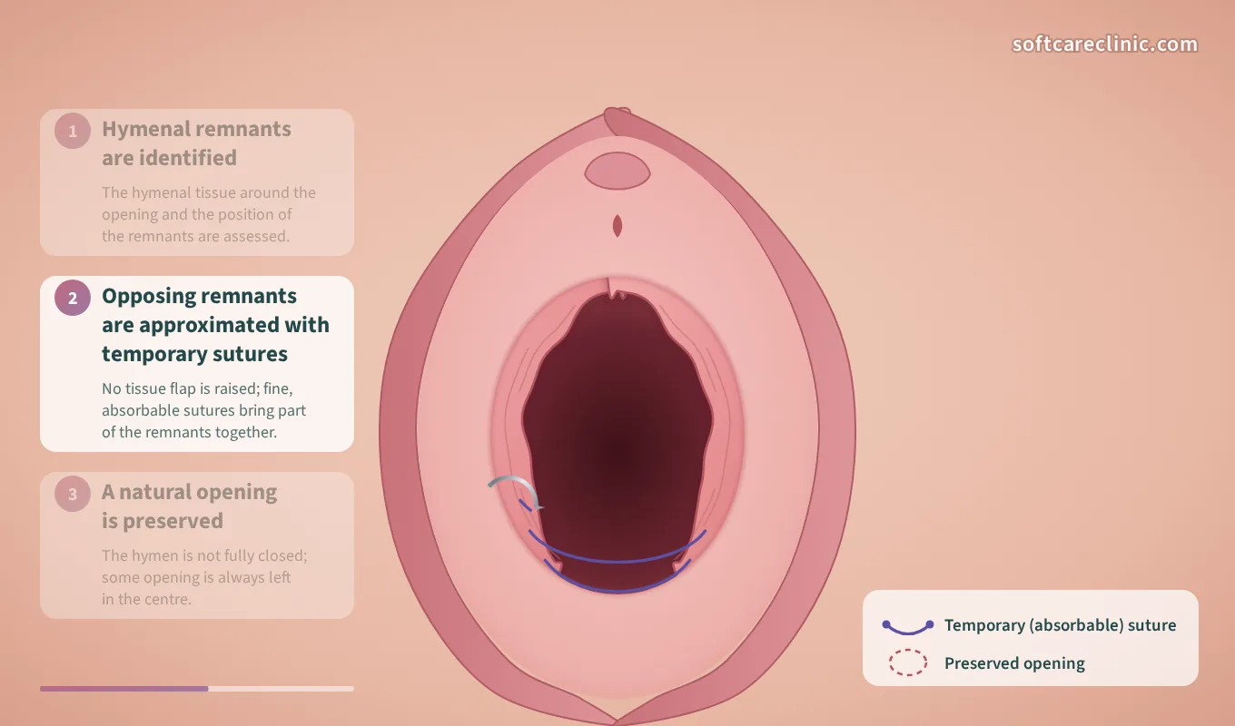 Шаг 2: Противоположные остатки сближаются временными швами Шаг 2: Противоположные остатки сближаются временными швами