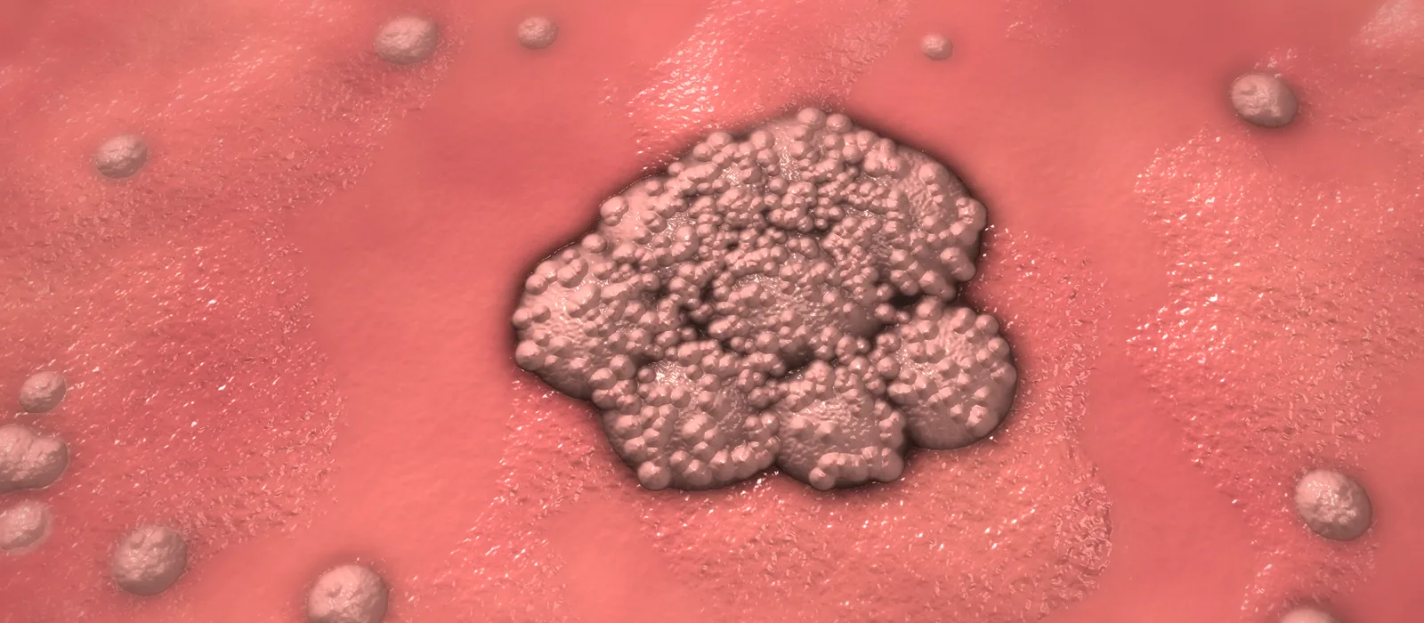 Immagine di una verruca genitale (condiloma) Immagine di una verruca genitale (condiloma)