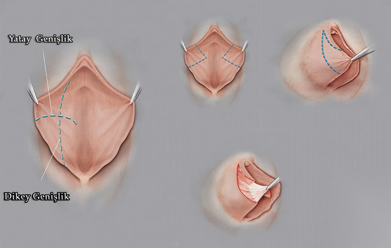 Labioplasti Teknikleri Labioplasti Teknikleri