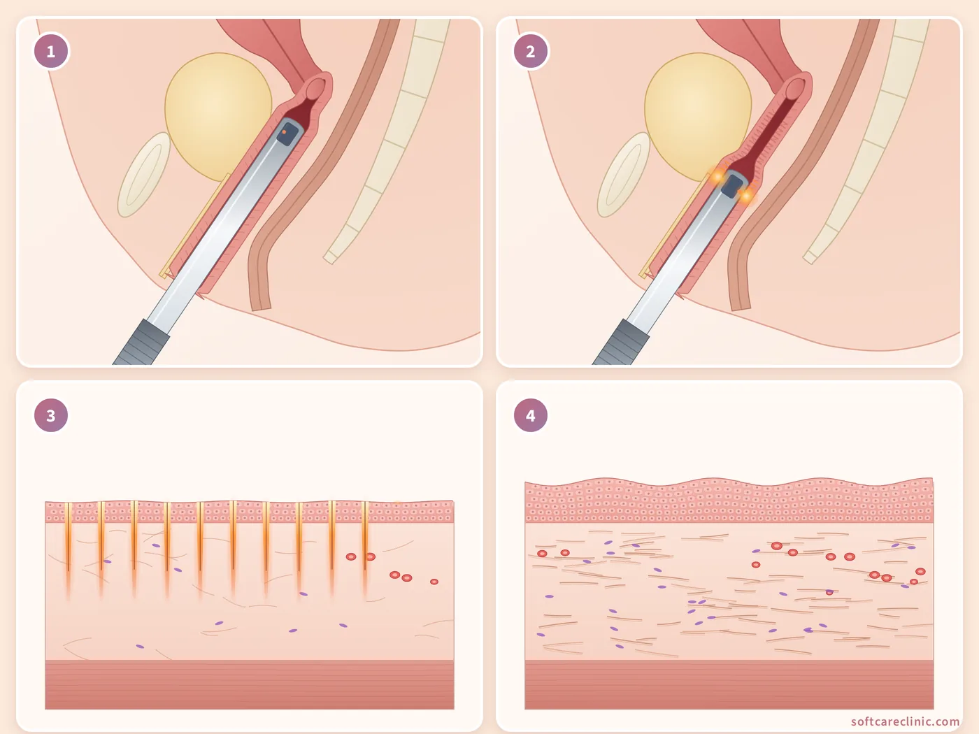 Étapes du resserrement vaginal au laser Étapes du resserrement vaginal au laser