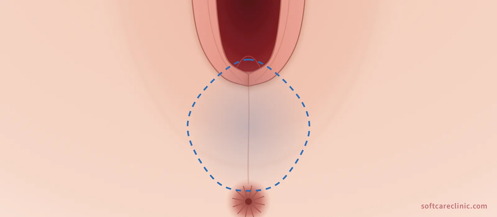 Perineoplastica delle cicatrici da parto Perineoplastica delle cicatrici da parto