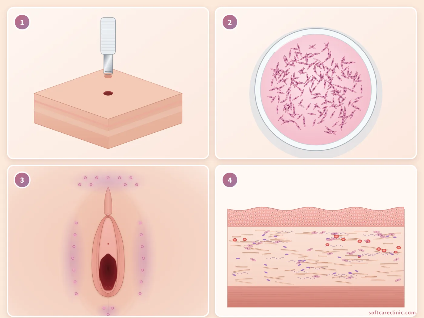 Fasi del trattamento con cellule staminali (fibroblasti) Fasi del trattamento con cellule staminali (fibroblasti)